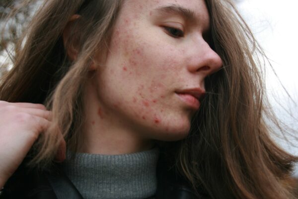 How do I deal with acne?