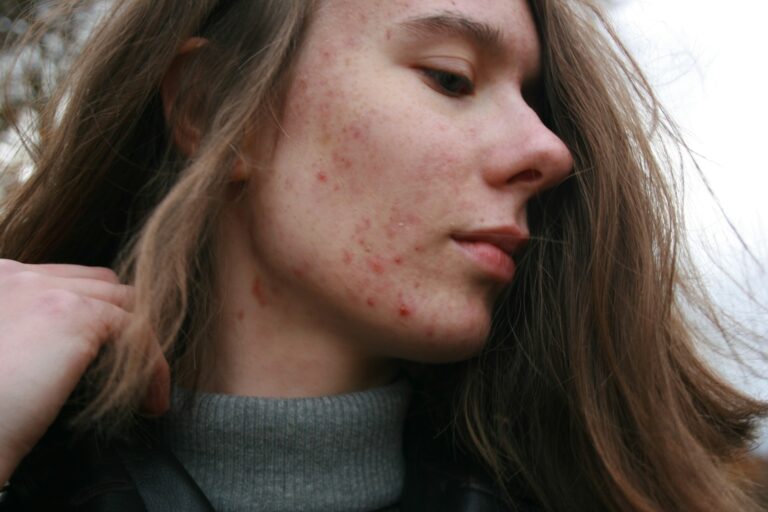 How do I deal with acne?