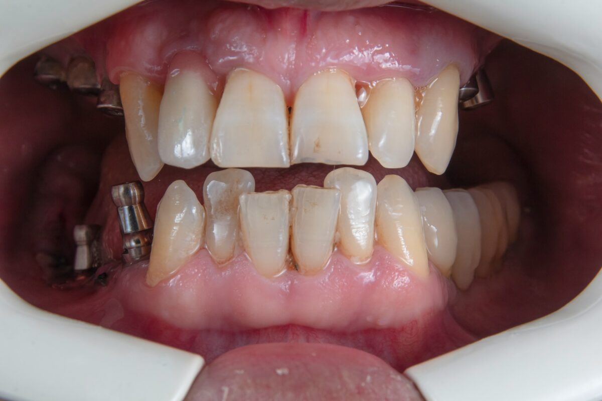 Can smoking affect your teeth and gums?