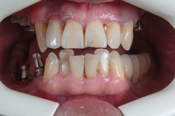 Can smoking affect your teeth and gums?