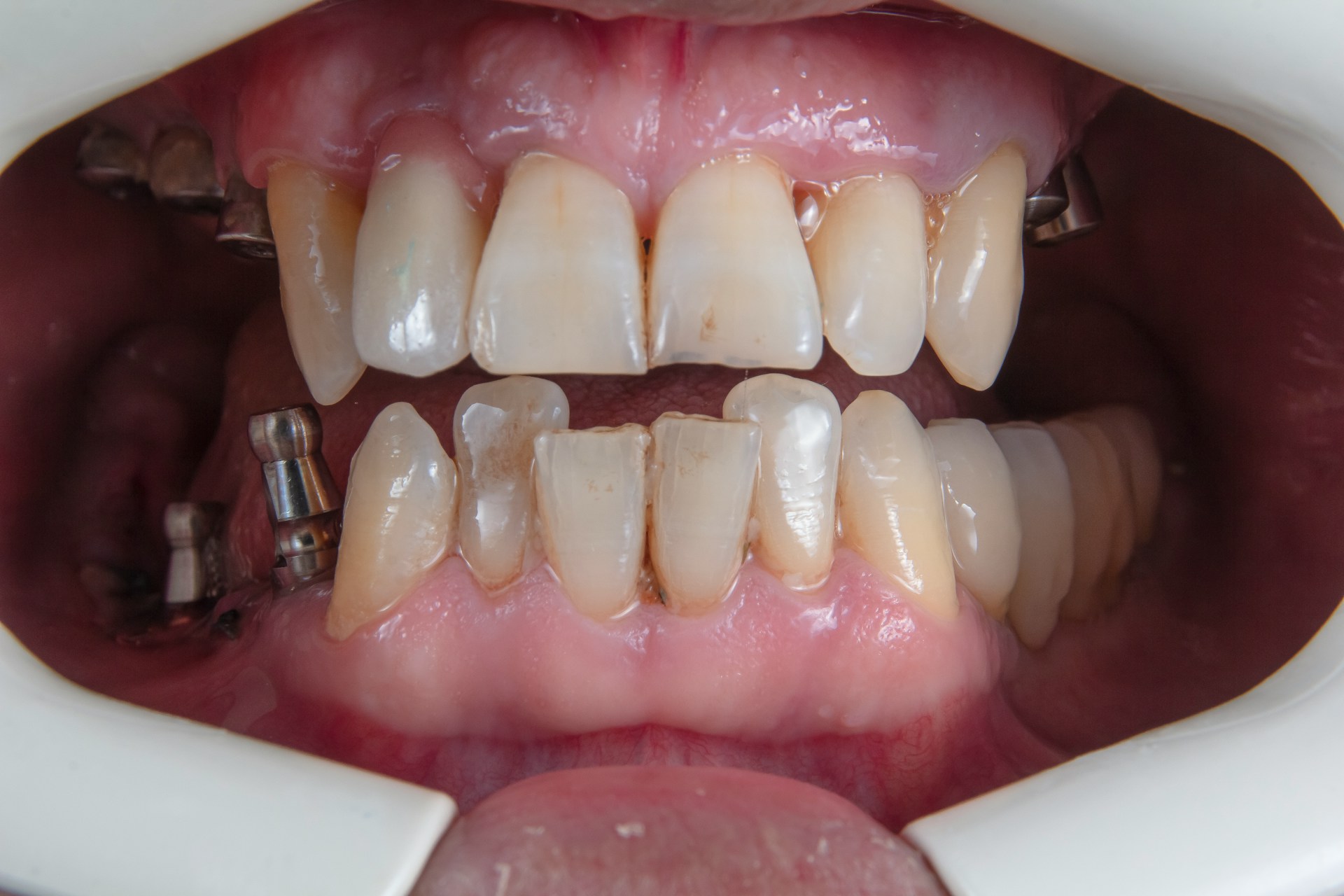 Can smoking affect your teeth and gums?