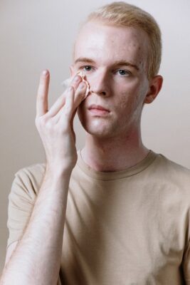 How can you prevent spots and acne?