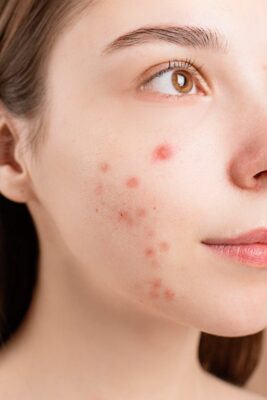 How long does acne last?