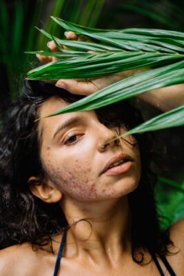 What is cystic acne?