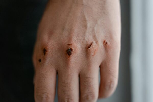 What is self-harm?